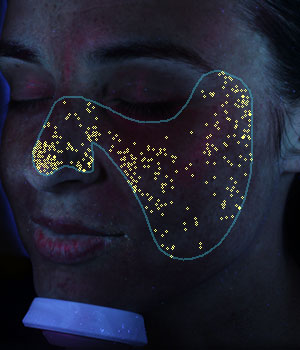 Visia Skin Analysis - bacteria