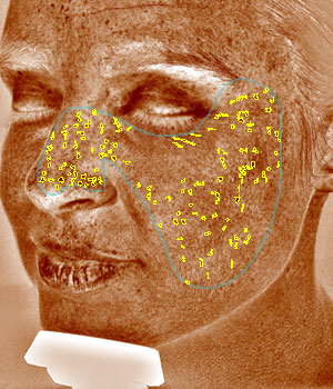 Visia Skin Analysis - brown spots