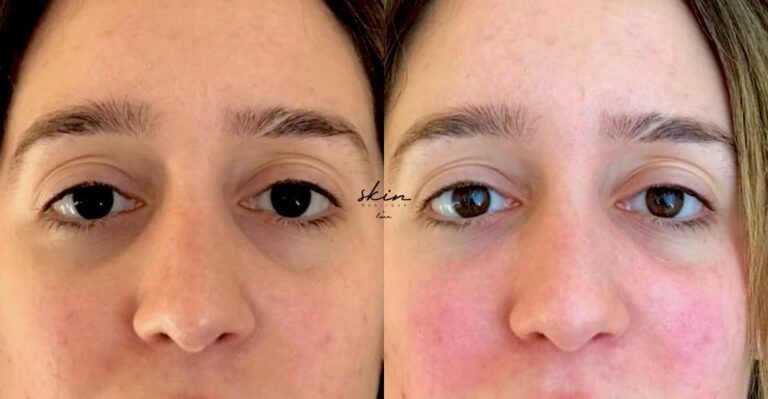 Filling Dark Circles with Hyaluronic Acid #2015