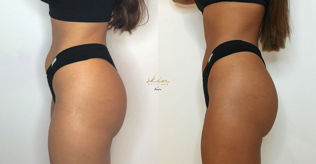 Tratamento com EXILIS ULTRA 360® no abdómen #15781