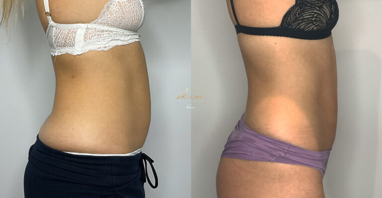 Treatment of localized fat in the abdomen and flanks #17687