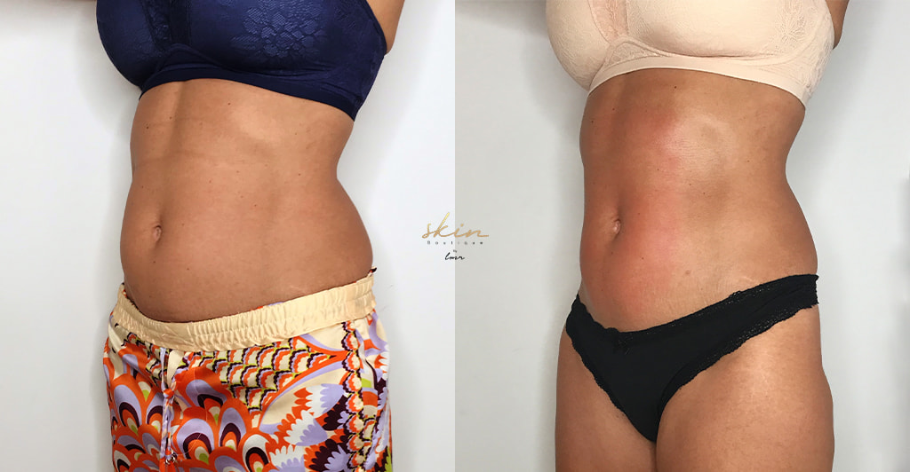 Tratamento com EXILIS ULTRA 360® no abdómen #22461