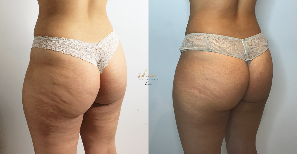Tratamento com EXILIS ULTRA 360® nas coxas EMSCULPT NEO® nos glúteos #25214