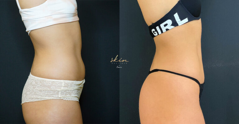 Treatment of localized fat in the abdomen and flanks #8761