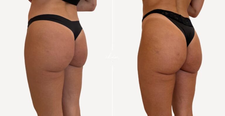 Buttock Augmentation and Remodeling with Biostimulators #8841