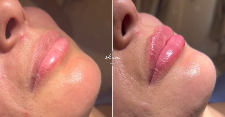 Lip Filler with Hyaluronic Acid #6720
