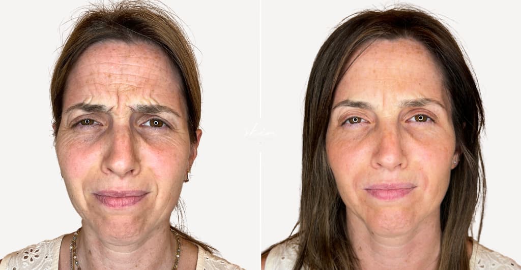 Skin Makeover - Harmonização Facial #32849