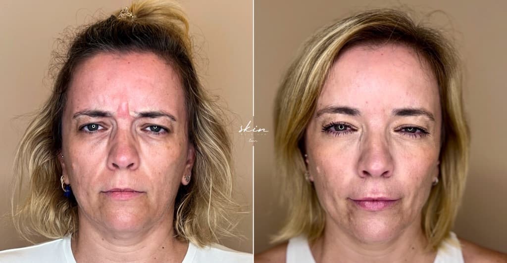 Skin Makeover - Harmonização Facial #33628