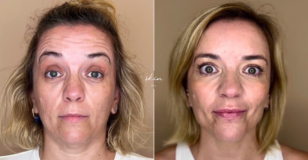 Skin Makeover - Harmonização Facial #33628