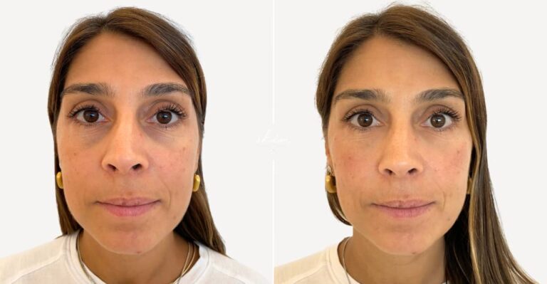 Filling Dark Circles with Hyaluronic Acid #21625