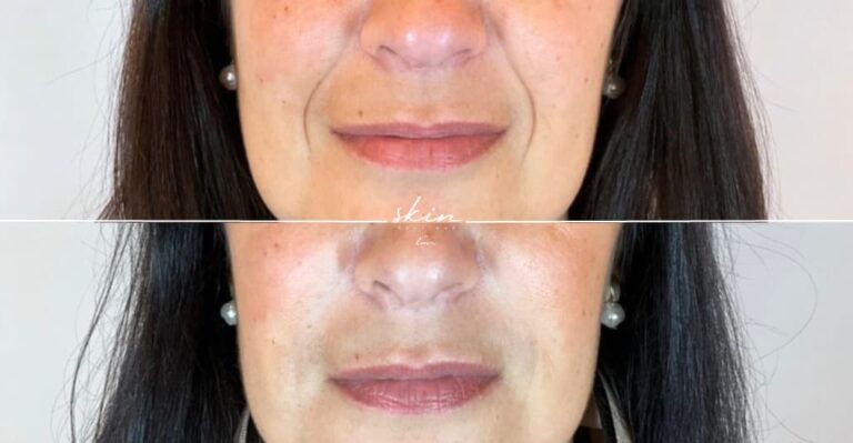 Filling Nasogenian Furrows "Chinese Moustache" with Hyaluronic Acid #21783
