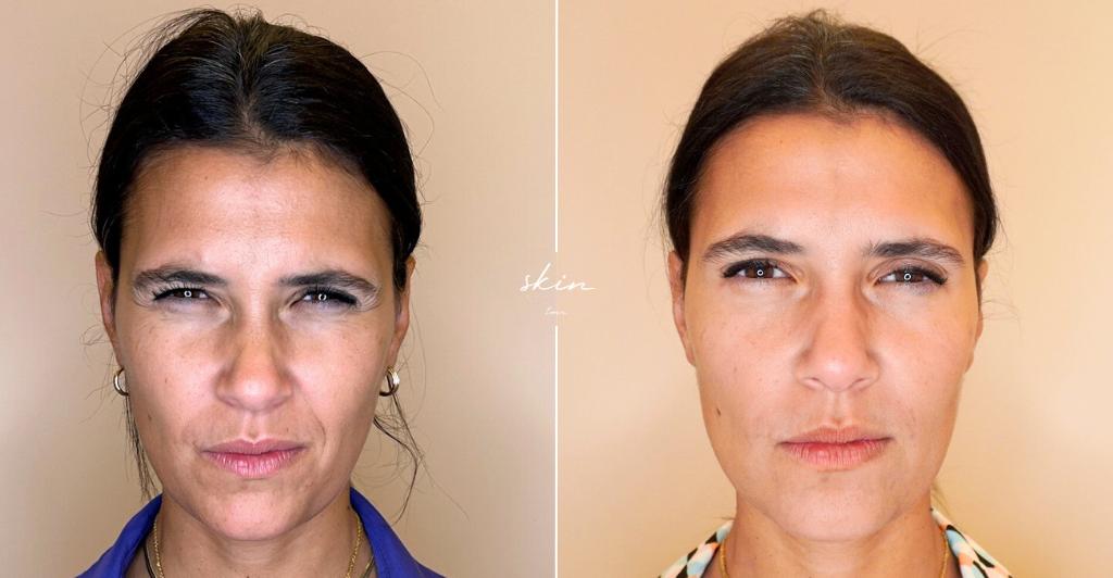 Harmonização Facial #1724