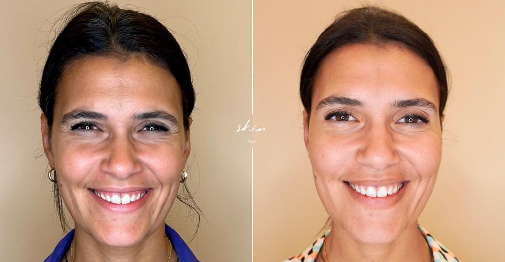 Harmonização Facial #1724