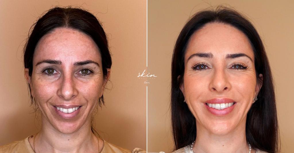 Casos Antes e Depois: Harmonização Facial - Skin Boutique