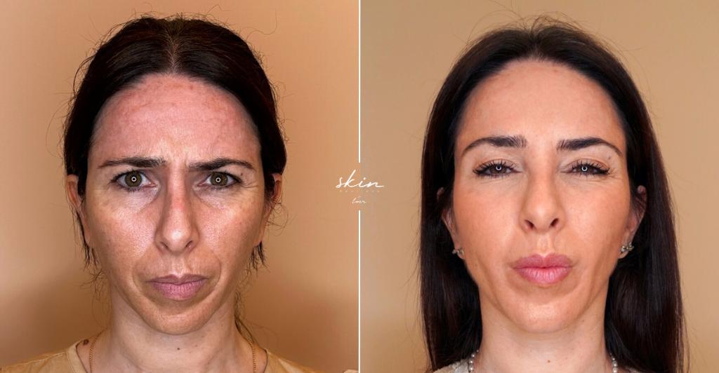 Skin Makeover - Harmonização Facial #2491
