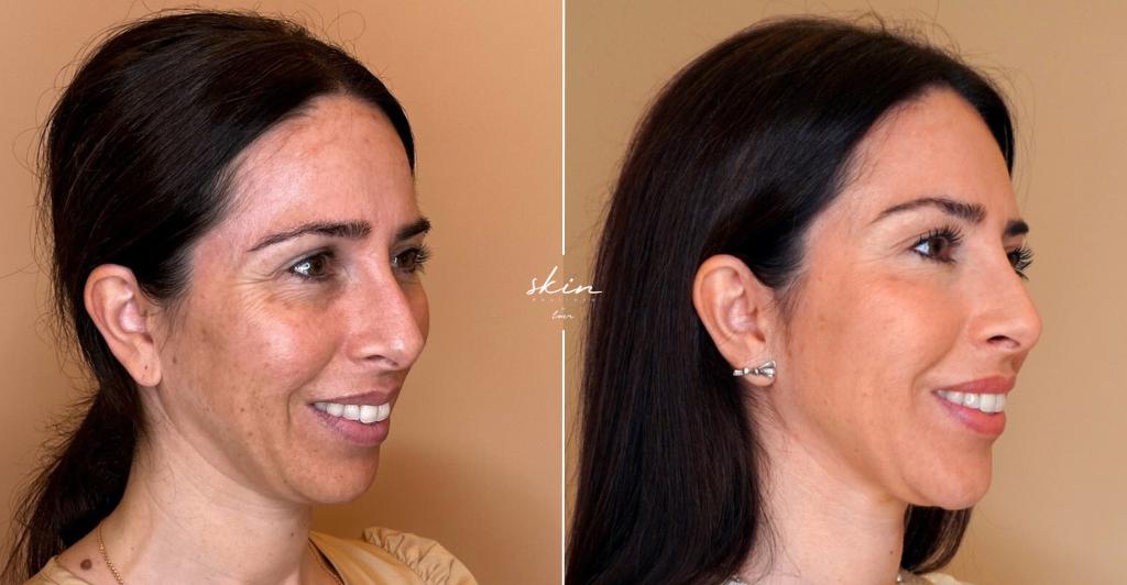 Skin Makeover - Harmonização Facial #2491
