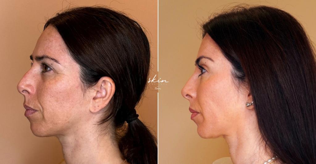 Skin Makeover - Harmonização Facial #2491