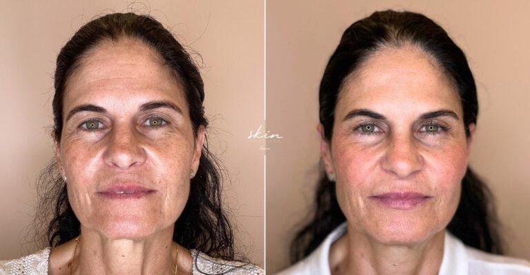 Skin Makeover - Facial Harmonization #3401