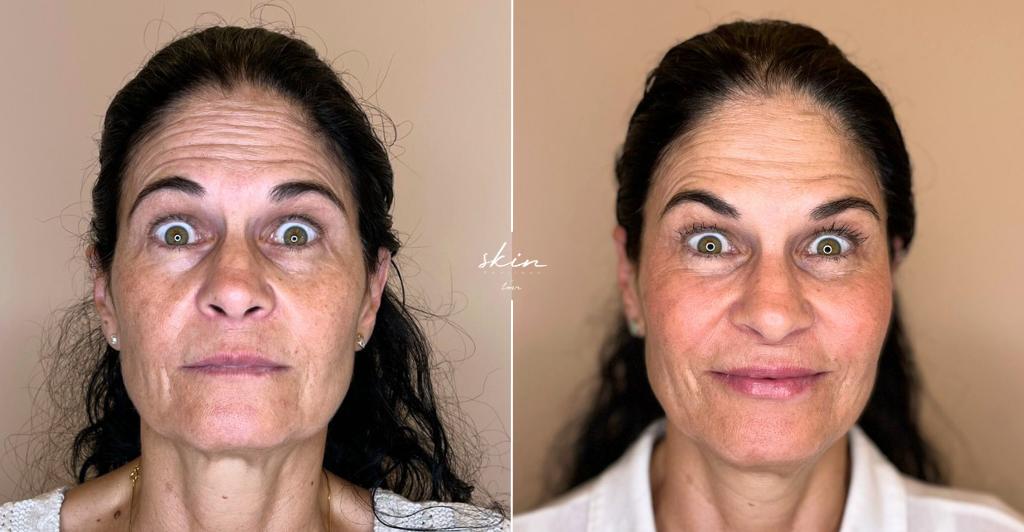Skin Makeover - Harmonização Facial #3401