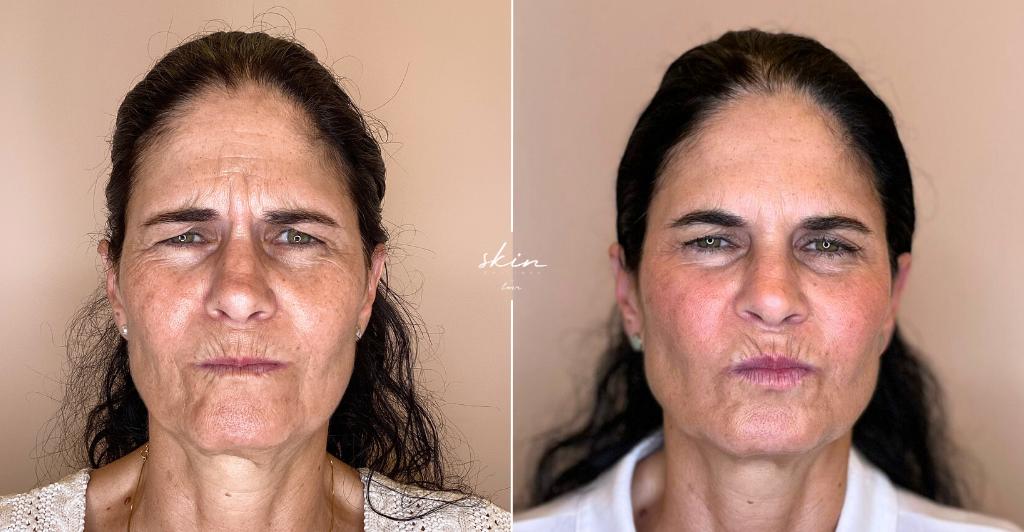 Skin Makeover - Harmonização Facial #3401