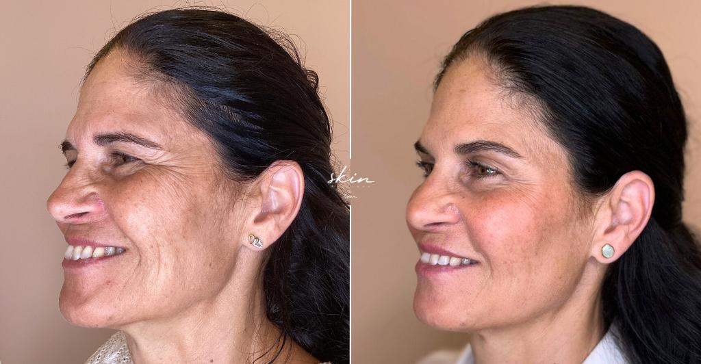 Skin Makeover - Harmonização Facial #3401