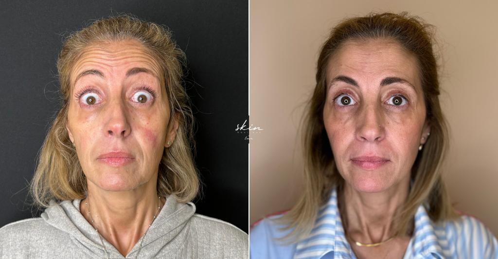 Harmonização Facial