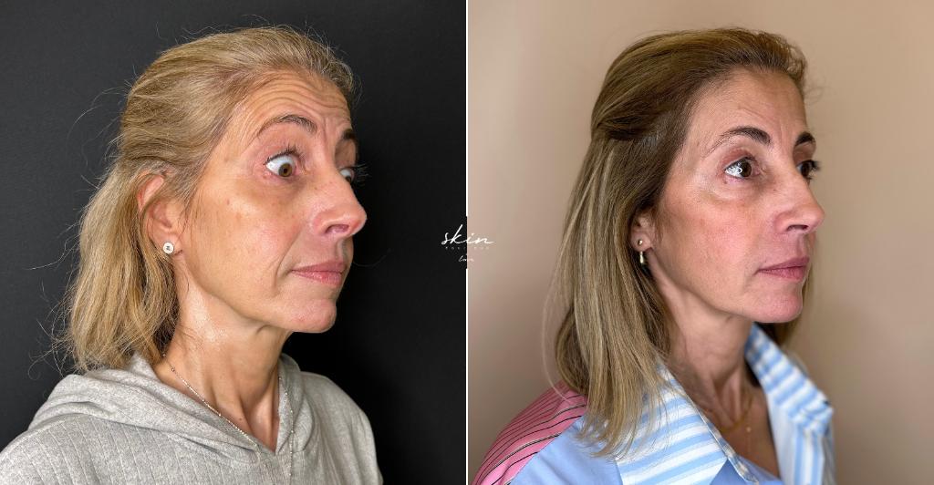 Harmonização Facial