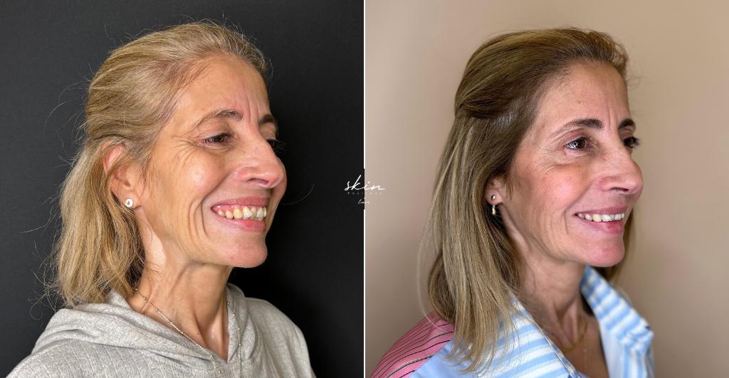 Harmonização Facial
