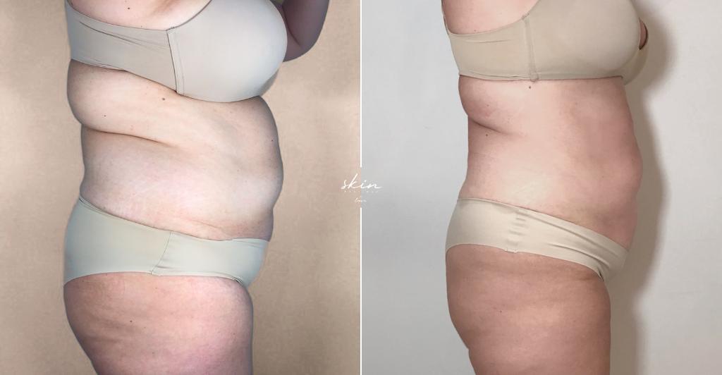Tratamento com EMTONE®, EXILIS ULTRA 360™ e EMSCULPT NEO®