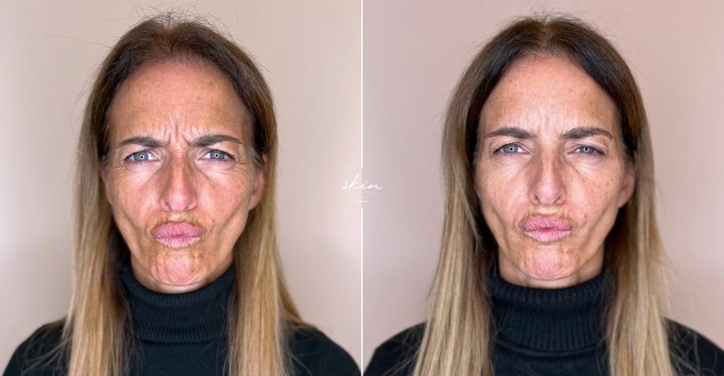 Harmonização Facial #41689_2