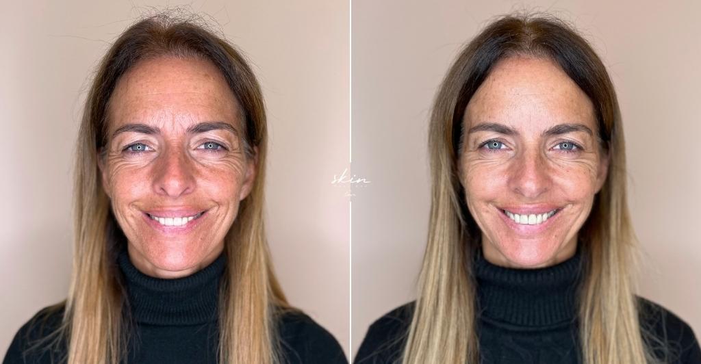 Harmonização Facial #41689_3