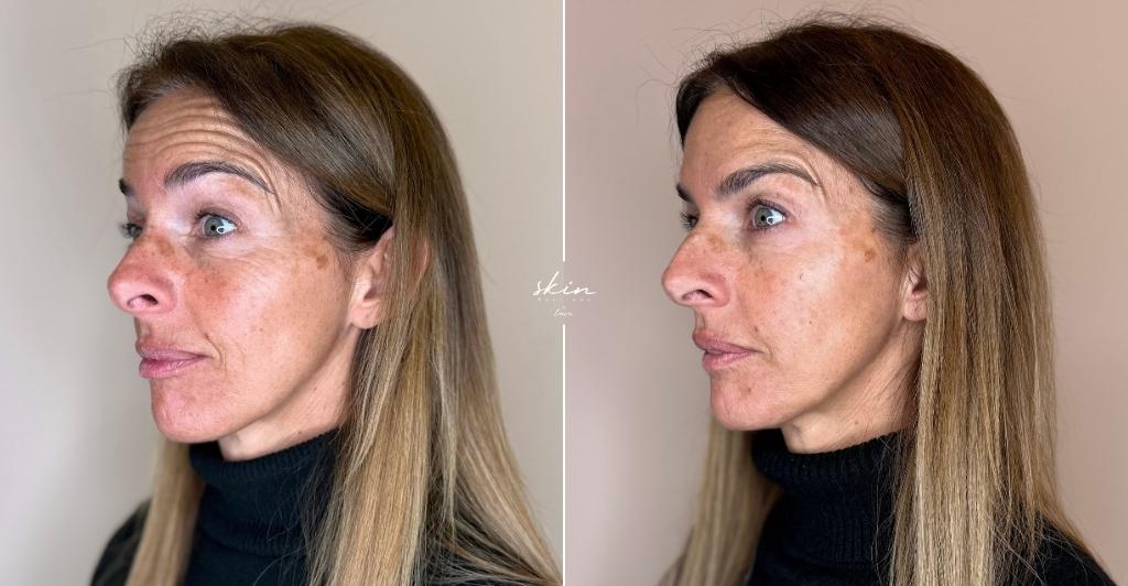 Harmonização Facial #41689_4