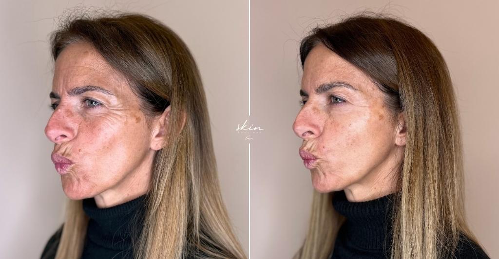 Harmonização Facial #41689_5