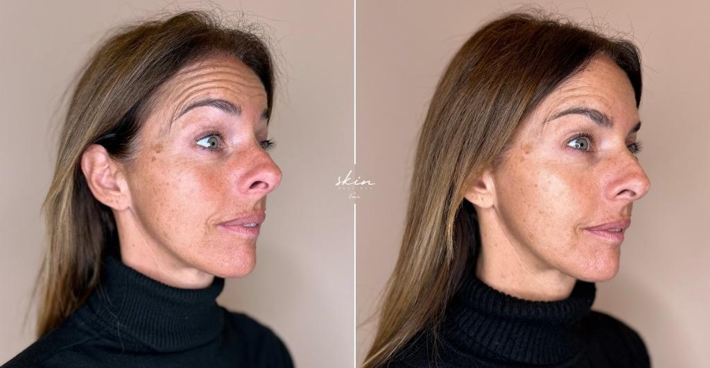 Harmonização Facial #41689_6