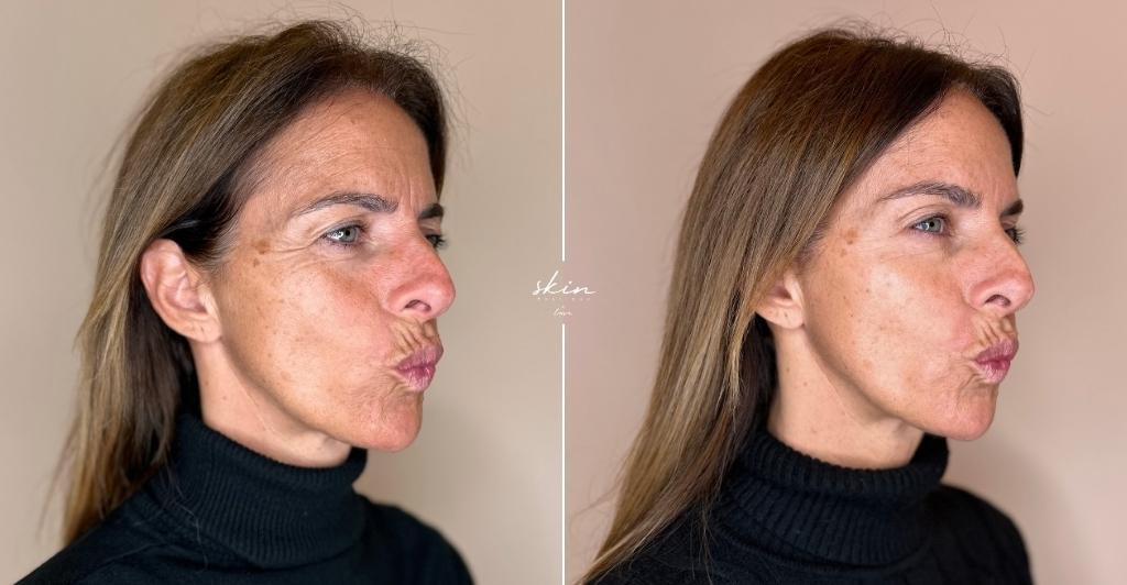 Harmonização Facial #41689_7