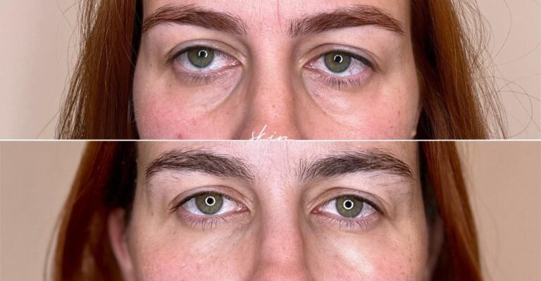 Filling dark circles with hyaluronic acid #41792
