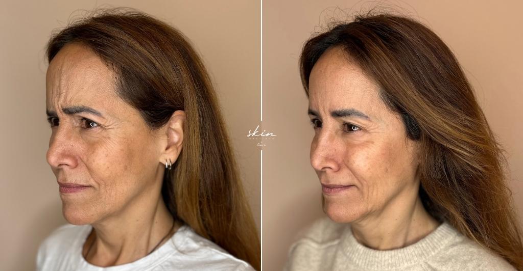 Harmonização Facial #42971_4