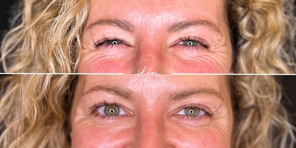 Botox #37191 skin boutique
