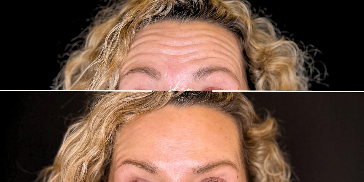 Botox #37191
