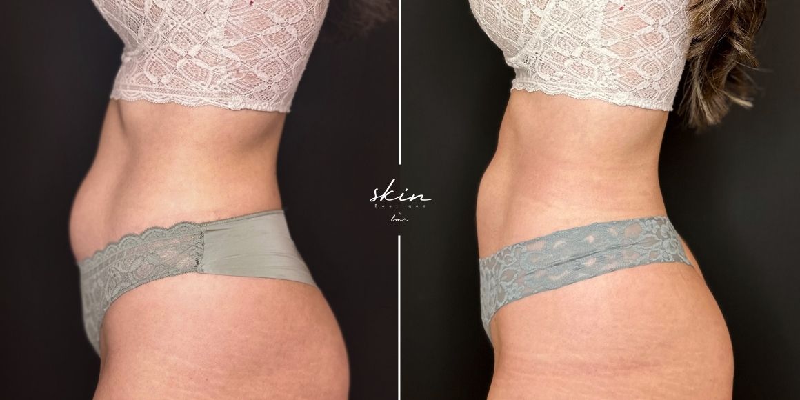 Coolsculpting + emsculpt (2)