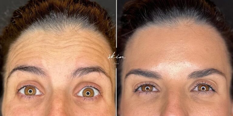 Botox wrinkle treatment #23791