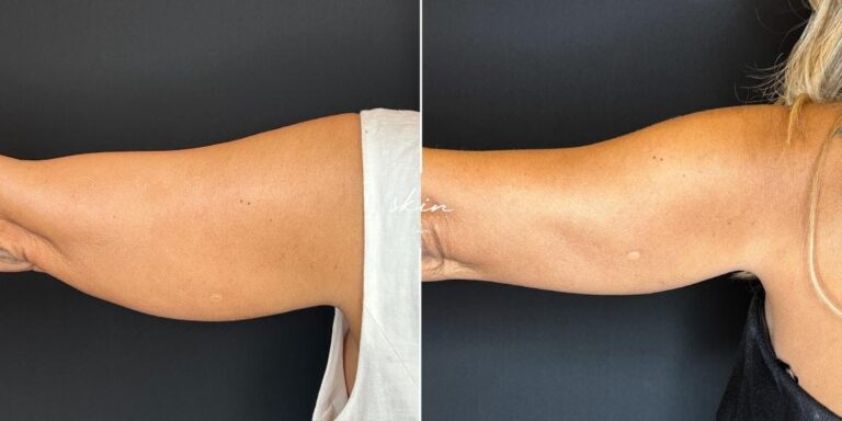 MPT Ultraformer sagging treatment #22828