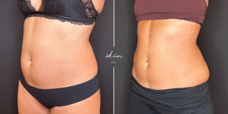 Treatment of sagging and localized fat with Ultraformer MPT #46715