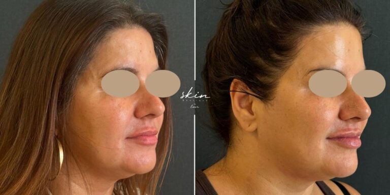 MPT Ultraformer Facial Treatment #48898