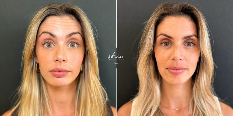 Botox wrinkle treatment #24770