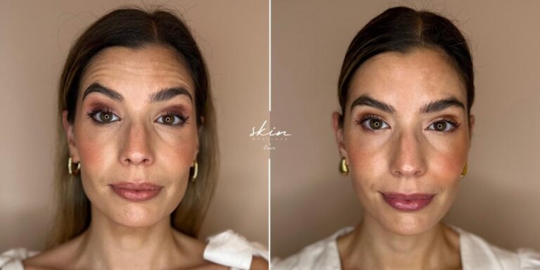 Botox wrinkle treatment #30271