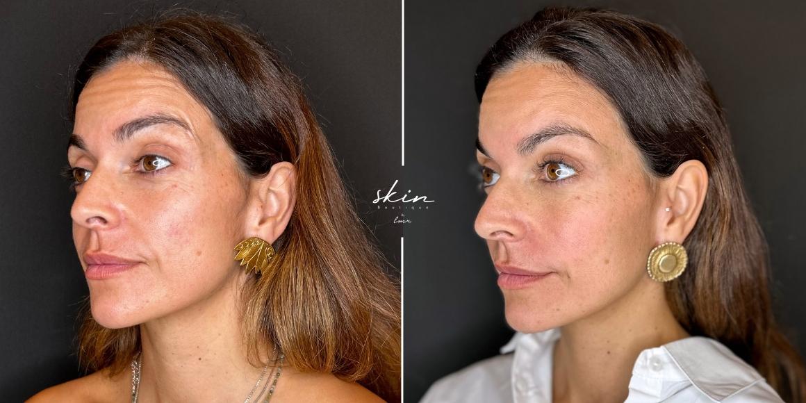 Tratamento de rugas com Botox e preenchimento do sulco nasogeniano #36946
