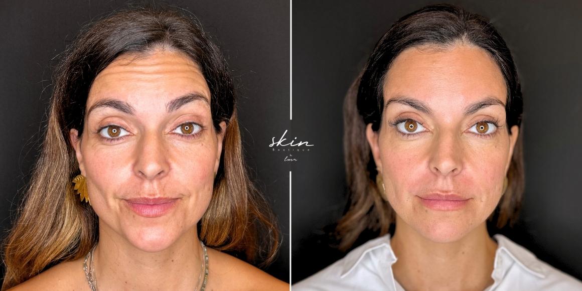 Tratamento de rugas com Botox e preenchimento do sulco nasogeniano #36946