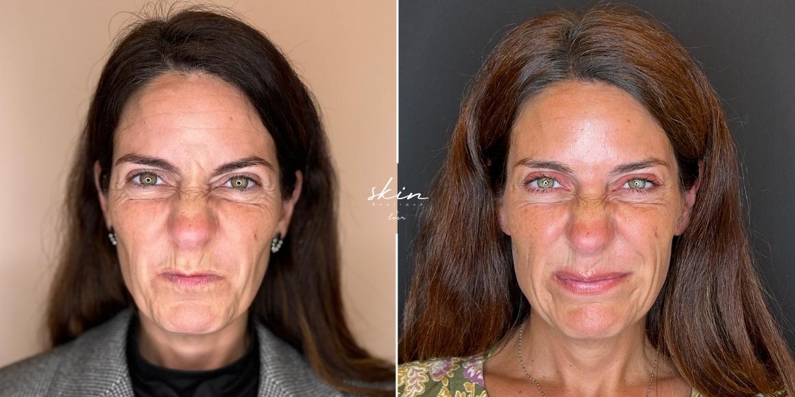 Tratamento de rugas e flacidez com Botox e Bioestimuladores de Colagénio #6644