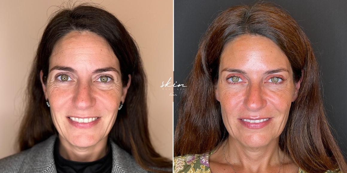 Tratamento de rugas e flacidez com Botox e Bioestimuladores de Colagénio #6644